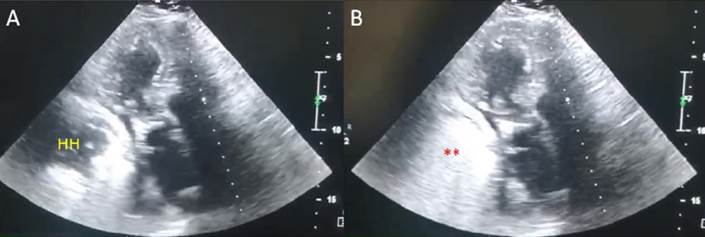 Figura 2: Ecocardiograma doppler en vista apical eje largo. A) Se observa una masa anecoica en su interior que corresponde a una hernia hiatal (HH) en el sector posterior de la aurcula izquierda y pared inferolateral del ventrculo izquierdo. B) Luego de que la paciente ingiere una bebida carbonatada (agua con gas) se observa como las burbujas pasan al interior del estmago (**) lo que confirma la presencia de hernia hiatal mediante ecocardiografa.