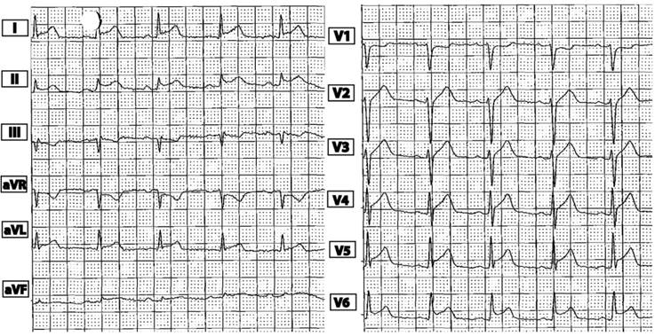 Figura 1: ECG de emergencia: ritmo sinusal, intervalos conservados, elevacin cncava del segmento ST en paredes inferior y lateral.