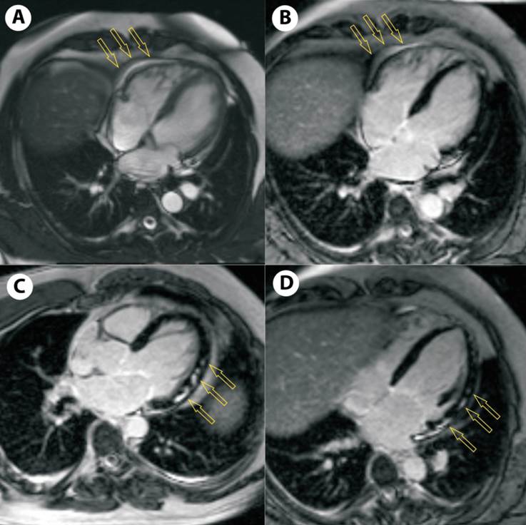 Figura 2: Resonancia magntica cardaca con gadolinio. A) y B) Derrame pericrdico (flechas). C) y D) Realce tardo con patrn parcheado subepicrdico o intramiocrdico en pared lateral (flechas).