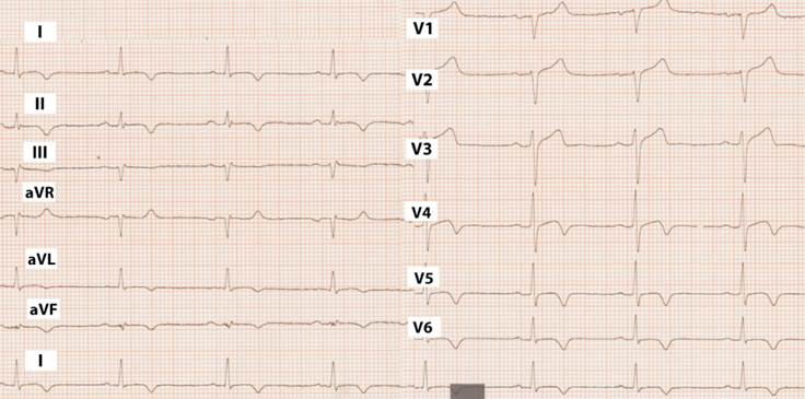 Figura 3: ECG control 4 semanas: bradicardia sinusal, intervalos conservados, ondas T negativas en paredes inferior y lateral.