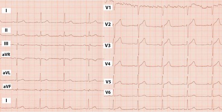 Figura 4: ECG control 12 semanas: ritmo sinusal, intervalos conservados, sin alteraciones del segmento ST y onda T.