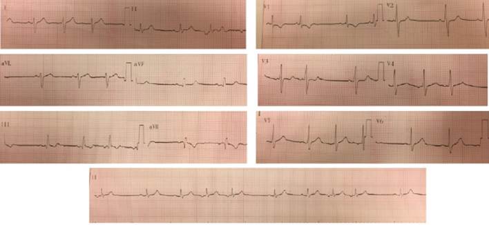 Figura 1: Electrocardiograma. Se observa un ritmo sinusal de 80 cpm que alterna con un ritmo auricular bajo, QRS fino, eje elctrico medio desviado a derecha (+120 grados), bloqueo incompleto de rama derecha.