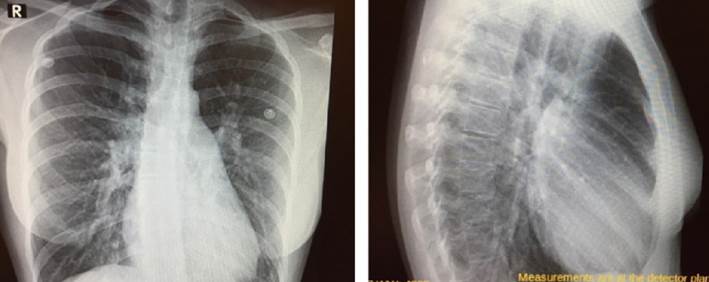 Figura 2: Radiografa de trax frente y perfil. A nivel de campos pleuropulmonares se observa una pltora pulmonar y a nivel mediastinal una silueta cardioaortopericrdica aumentada, a expensas de aurcula y ventrculo derecho, con un arco pulmonar prominente.