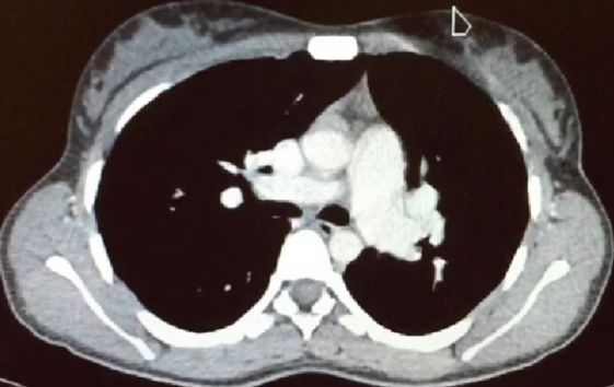 Figura 3: Angiotomografa de trax con contraste. Se observa la vena pulmonar superior derecha (VPSD) desembocando a nivel de la vena cava superior (VCS).