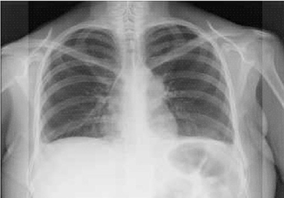 Telerradiografía de tórax. Ensachamiento mediastinal como hallazgo para evaluación preoperatoria.