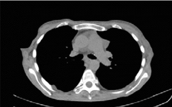 Tomografía axial computarizada de tórax. Tumoración mediastinal anterior, con discreto derrame pleural derecho.