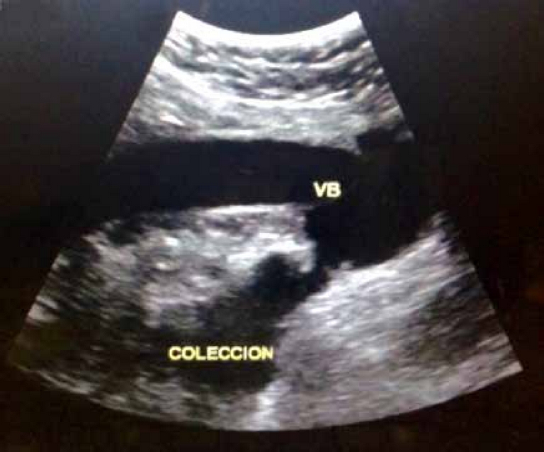 En el ultrasonido se apreció vesícula biliar con salida de líquido
                        (bilis) a la cavidad peritoneal (caso 1).