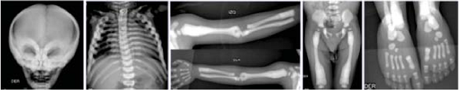 Con las radiografías de diferentes huesos se observa la osteoesclerosis característica de la osteopetrosis maligna infantil.