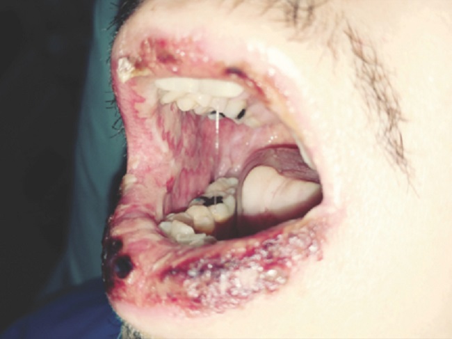 Edema, eritema y escaras en labios, además de placas blanquecinas en mucosa oral.
