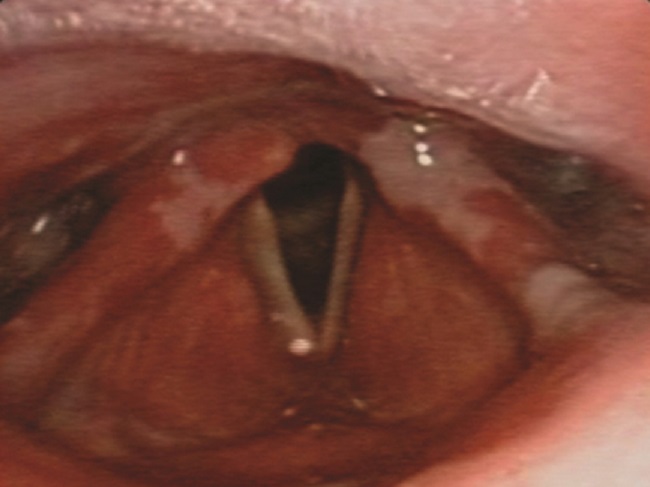 Placas blanquecinas en mucosa de hipofaringe, con edema circundante a nivel de ambos senos piriformes y valleculas.