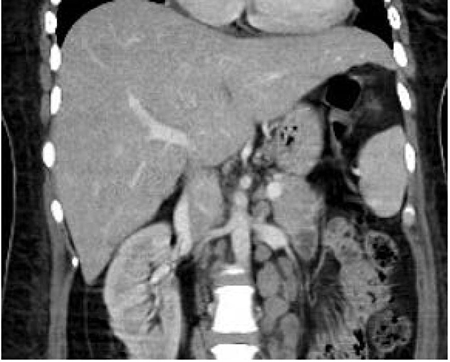 Tomografía axial computarizada toracoabdominal: aumento del tamaño del hígado, principalmente del lóbulo izquierdo; bazo con eje de 14 cm, hipodensidades mal delimitadas de entre 5 y 15 mm, múltiples crecimientos ganglionares en las cadenas paratraqueales inferiores bilaterales, precavales, paraaórticas y mesentéricas, con pérdida de la morfología del hilio graso. 