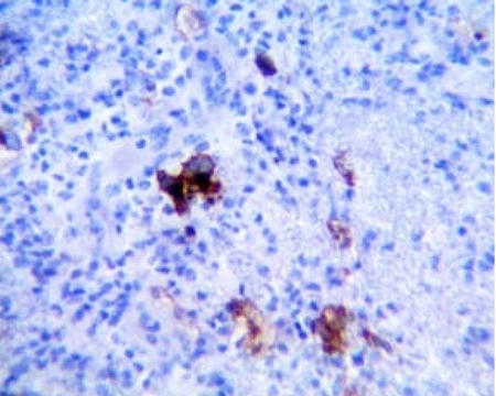 CD30 positivo membranal y en aparato de Golgi de células neoplásicas. Inmunohistoquímica 40×.