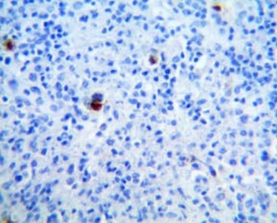 CD15 positivo en aparato de Golgi de células neoplásicas. Inmunohistoquímica 40×.