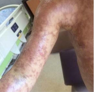 En el segundo día de hospitalización, las lesiones se tornaron generalizadas, algunas palpables y que no desaparecían a la digitopresión. 