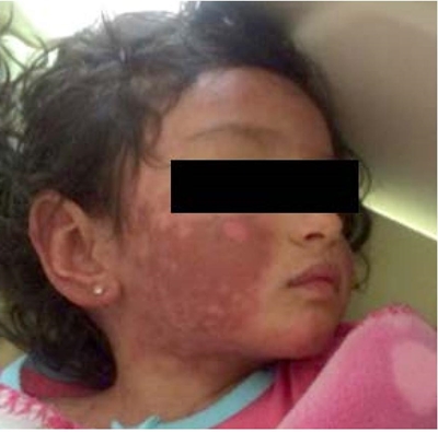 En el segundo día de hospitalización, la ampolla de la cara se esfaceló.