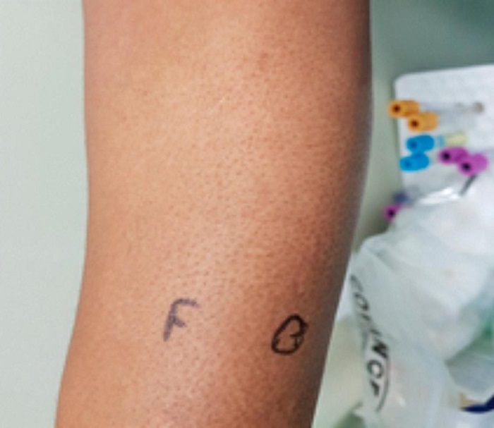 Urticaria por calor positiva después de la prueba de	provocación.
