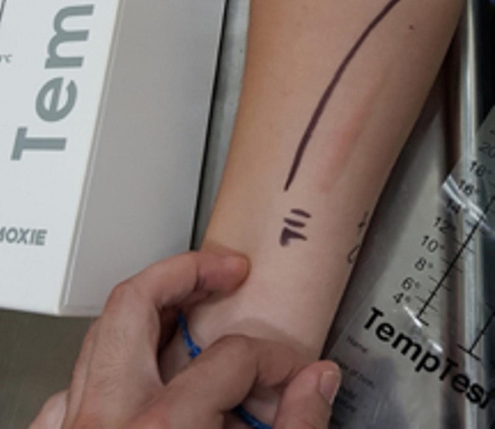 Urticaria por frío positiva después de la prueba de provocación.