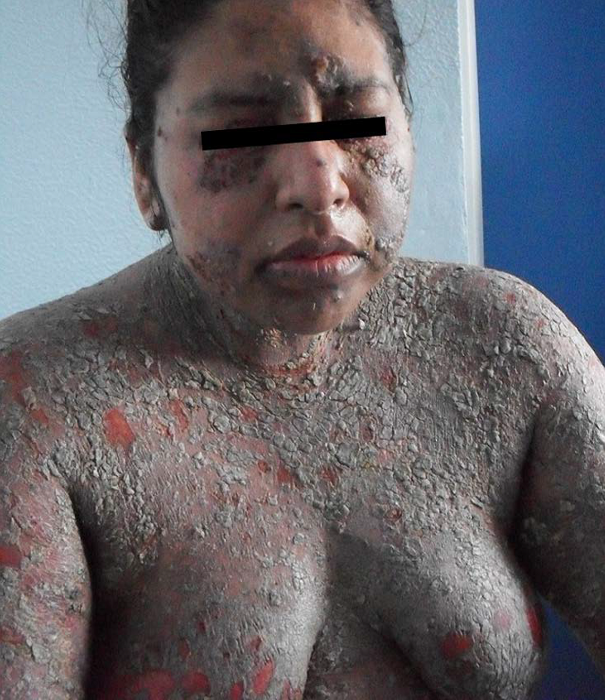 Pénfigo vulgar mucocutáneo severo. Dermatosis generalizada que afecta todos los segmentos corporales, principalmente tronco y extremidades, caracterizada por ampollas flácidas y friables, así como áreas de piel denudada. Nótese la presencia de lesiones en el área de labio-bermellón