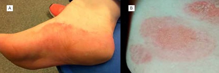 A) Placas, vesículas y exudado. B) Placas eccematosas en el lugar de contacto de electrodos para electrocardiograma. 