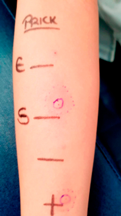 Prueba de punción cutánea con sugammadex (S) a 100 mg/mL. Con rocuronio (E) a 10 mg/mL, suero salino (−) e histamina (+) a 10 mg/mL.