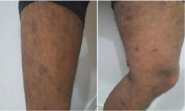 Lesiones iniciales que present&oacute; el paciente en miembros inferiores, con formato numular, hipercr&oacute;micas, algunas con leve descamaci&oacute;n. 