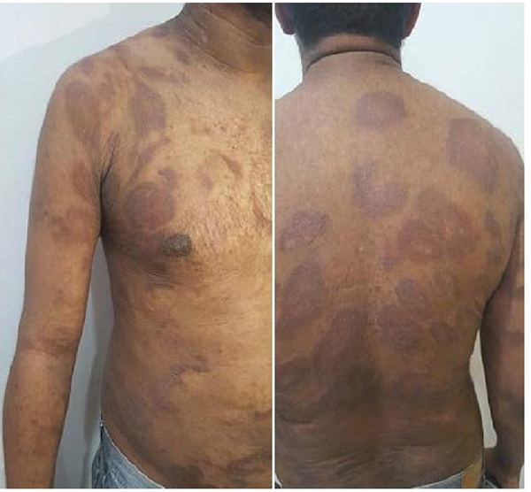Lesiones polic&iacute;clicas, la mayor&iacute;a con formato anular, bordes infiltrados, eritematoviol&aacute;ceas, en dorso anterior y posterior, abdomen y miembros superiores. Con m&aacute;s infiltraci&oacute;n y descamaci&oacute;n. 