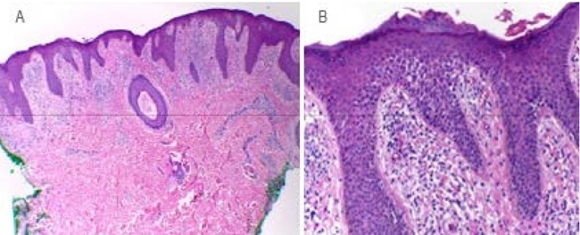 Caracter&iacute;sticas histol&oacute;gicas de la dermatitis at&oacute;pica. A) Acantosis irregular, infiltrado inflamatorio y espesamiento de fibras de col&aacute;geno. B) Peque&ntilde;os focos de paraceratosis, espongiosis y algunos extravasamientos de hemat&iacute;es. 