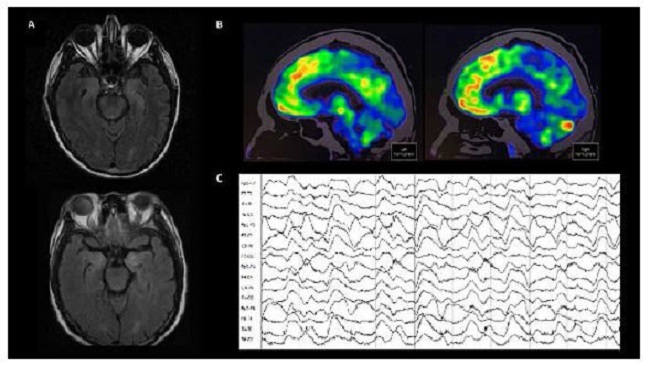 A) Resonancia magnética cerebral ponderada en T2 FLAIR con cortes axiales a nivel del lóbulo temporal medial. Se observa incremento en la intensidad de señal de las cabezas de los hipocampos bilateralmente. B) 18-FDG PET demuestra un hipometabolismo occipital medial. C) Electroencefalograma con patrón extreme delta brush. Las imágenes pertenece a una mujer de 16 años con cuadro grave de encefalitis anti-NMDAr.