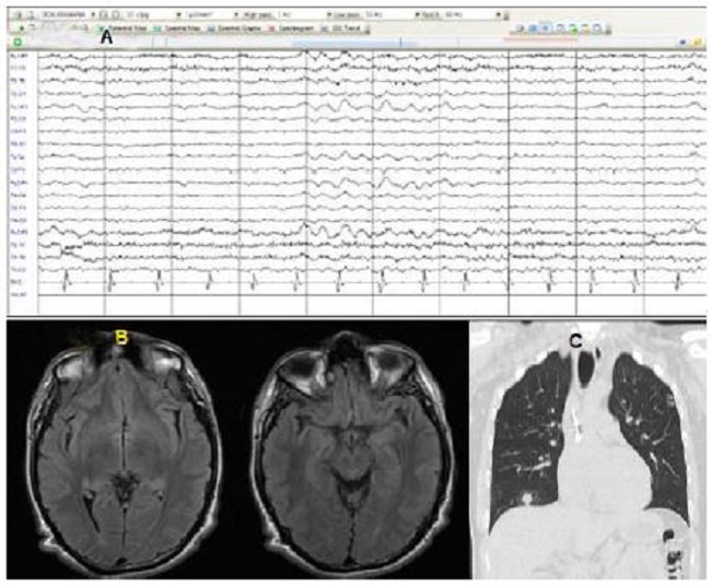A) electroencefalograma anormal por ondas lentas polimorfas y monomorfas, no rítmicas, de mediana a gran amplitud en frecuencia delta theta de 3-5 Hz en región frontocentral bilateral. B) Resonancia magnética de encéfalo en secuencia T2 FLAIR corte axial, que presenta cambios de intensidad en lóbulos temporales. C) Tomografía axial computarizada de tórax corte sagital, que muestra nódulo pulmonar hacia la base derecha.