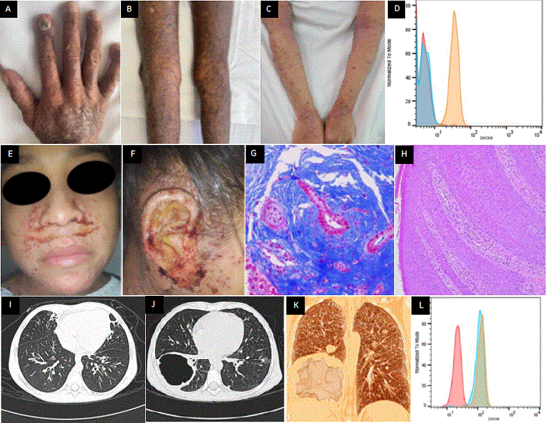 A) Onicomicosis distrfica total en el dedo ndice, liquenificacin en el dorso de la mano. B) Prurigo nodular. C) Liquenificacin, descamacin fina y costras hemticas. D) Histograma que muestra la expresin de la protena DOCK8 por citometra de flujo en un paciente con deficiencia de DOCK8 antes del trasplante de clulas progenitoras hematopoyticas (TCPH); en rojo el control de isotipo, en azul el paciente, en amarillo el control sano. Existe ausencia de la expresin de la protena. E y F) Eccema herptico, presencia de vesculas superficiales que al romperse dejan costras melicricas y reas denudadas de piel. G) Biopsia heptica con tincin tricrmica de Masson, 40, con presencia de fibrosis concntrica en “capas de cebolla” en azul intenso con obliteracin del conducto biliar; el infiltrado inflamatorio portal por linfocitos de aspecto maduro. H) Biopsia de piel por tincin H-E, 10. Presencia de acantosis difusa, paraqueratosis, espongiosis, exocitosis y queratinocitos apoptticos; dermis papilar con infiltrado linfocitario y macrofgico, hallazgos caractersticos del eccema asociado a EII. I) Tomografa axial de alta resolucin (TACAR), corte axial, en la que se observan bronquiectasias con engrosamiento peribronquial y la presencia de neumatoceles, a nivel del ngulo cardiofrnico del lado derecho y adyacentes al ventrculo izquierdo. J) TACAR que muestra neumatocele en lbulo inferior derecho y ndulos multifocales bilaterales dispersos en todos los lbulos. K) Reconstruccin de TACAR 3D con presencia de masa de aspecto qustico con nodulaciones en su interior correspondiente a granulomatosis linfomatoidea. L) Histograma que muestra la expresin de la protena DOCK8 por citometra de flujo en un paciente con deficiencia de DOCK8 despus del trasplante de clulas progenitoras hematopoyticas (TCPH); en rojo el control de isotipo, en azul el paciente. El paciente presenta una expresin de la protena DOCK8 similar a la del control sano.
