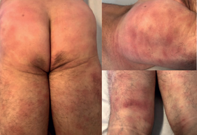 Reaccin cutnea con placas purpricas y eritematosas sin descamacin, localizadas en
							los glteos y las extremidades inferiores.