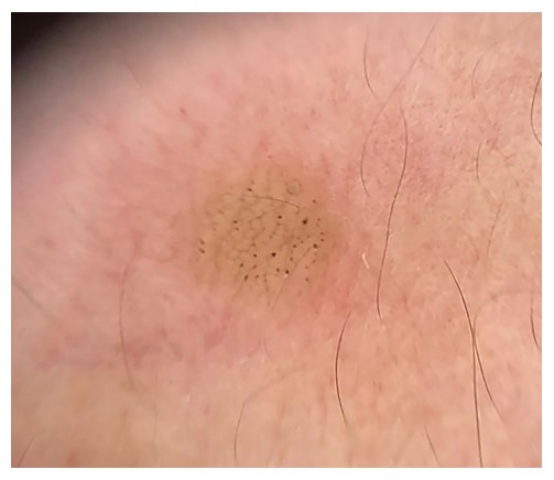 Lesin pigmentada de color marrn-amarilla, con una fina red simtrica y puntos negros de distribucin al azar.