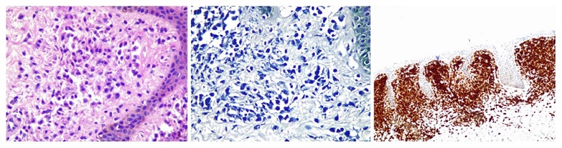 A) Tincin con H-E (40X), se observa una poblacin de mastocitos monomorfos, con ncleos excntricos y citoplasma de aspecto granular basfilo. B) Tincin con azul de toluidina (40X), que muestra grnulos con leve metacromasia. C) Inmunohistoqumica (10X) que evidencia positividad para CD-117.