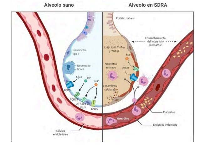 Representacin esquemtica de un alveolo sano y con SDRA. Lado izquierdo: Alveolo sano. Epitelio alveolar y endotelio vascular ntegros; existe correcta expresin y funcin de los transportadores de iones y de la acuaporina 5, lo que permite la adecuada depuracin del fluido alveolar (DFA). Contrastando con esta imagen, Lado derecho: Alvolo en SDRA. El epitelio se encuentra lesionado, muestra menor expresin y funcin de los transportadores inicos y de acuaporina 5; existe infiltracin del espacio intra-alveolar por neutrfilos, debido a la activacin del endotelio. El infiltrado celular secreta mediadores proinflamatorios que daan el alvolo y promueven la acumulacin de lquido, lo que favorece el edema pulmonar. Las flechas indican la direccin en la que fluyen los iones y el agua. Cl-: cloro; Na+: sodio; AQP5: acuaporina 5; TCRCF: canales de Cl- reguladores de la conductancia transmembranal en fibrosis qustica; ATPasa de Na+/K+: ATPasa de sodio/potasio; ENaC: canales de sodio epiteliales; IL1b: interleucin1b; IL-8: interleucina 8; TNF-a: factor de necrosis tumoral alfa; TGF-b: factor de crecimiento transformante beta. Imagen creada en BioRender.com
