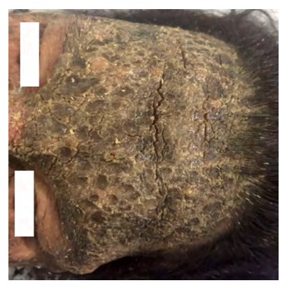 Lesiones costrosas gruesas (piel “acartonada”) de diverso tamao en la regin frontal del rostro, que se extienden hacia los parpados, la nariz y el cuero cabelludo. Tambin se observan costras melicricas (signo de Nikolsky negativo).