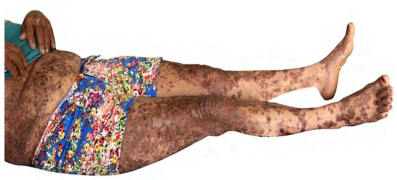 Lesiones eritematocostrosas de predominio abdominal. Se evidencia la piel de aspecto “acartonado” en los miembros inferiores, con leve eritema y mayor descamacin respecto al resto de las reas afectadas.