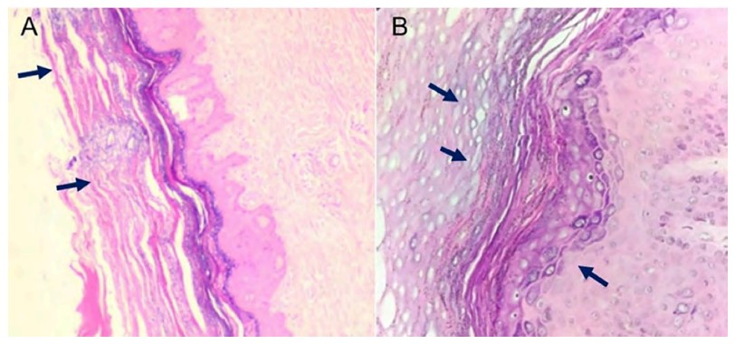 A) Piel con epidermis acantsica, hiperqueratosis y paraqueratosis focal, con acantlisis superficial (tincin con hematoxilina y eosina; 4X). B) Se observa discreta exocitosis y algunas mitosis en diferentes zonas. La dermis muestra papilas con vasos tortuosos y dilatados, rodeados por infiltrado mononuclear superficial (tincin con hematoxilina y eosina; 40X). Fuente: laboratorio de patologa, Hospital Regional de la Orinoqua.