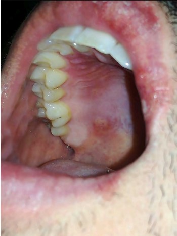 Formacin de lceras en la cavidad bucal.
