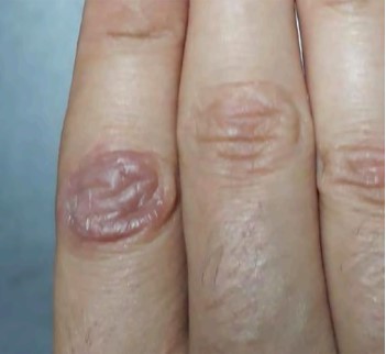 Lesin eritematosa fija en la segunda falange de la mano derecha.