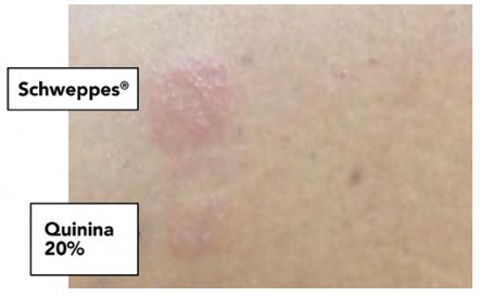 Prueba epicutnea que confirma la reaccin adversa a los productos.