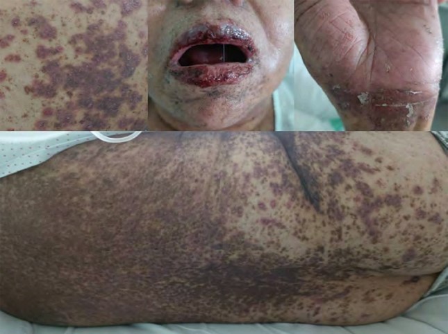 Lesiones liquenoides.