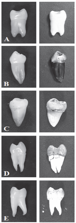 Teeth before (left) and after (right) being subjected to high temperatures.
We can observe the progressive separation of the DEJ in the cervical third of
the crown. A. 200&deg;C; B. 400&deg;C; C. 600&deg;C, D. 800&deg;C, and E. 1000&deg;C.