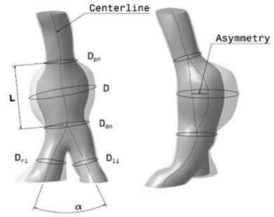 Representaci&oacute;n esquem&aacute;tica de los principales par&aacute;metros geom&eacute;tricos de los AAA basados en la l&iacute;nea central del lumen.