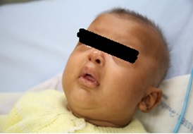 Lactente
com letargia, fácies de "passarinho e hiperpigmentação de pele. Uberaba,
2016.