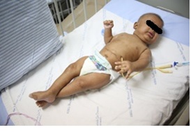 Lactente com hipertonia generalizada, mãos e pés em garras, movimentos em
blocos, tetraparesia espástica. Uberaba, 2016.