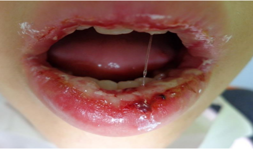 Paciente pedi&aacute;trico
diagnosticado com mucosite oral grave pelo &iacute;ndice
OAG. Jo&atilde;o Pessoa, 2017.