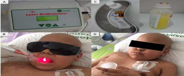 Manejo terap&ecirc;utico
dos pacientes oncopedi&aacute;tricos (bochechos com a
solu&ccedil;&atilde;o de mucosites oral e laserterapia de baixa pot&ecirc;ncia). Laserterapia de baixa pot&ecirc;ncia
(A/B) associado a solu&ccedil;&atilde;o para bochecho (C/D). Jo&atilde;o Pessoa, 2017.