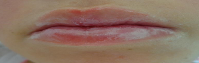  Paciente pedi&aacute;trico
ap&oacute;s tratamento da MOG com solu&ccedil;&atilde;o oral e laserterapia.
Jo&atilde;o Pessoa, 2017.