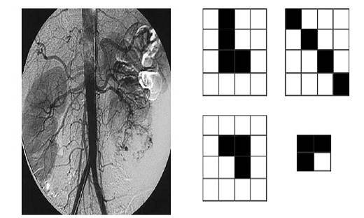 Imagen original (arteriograf&iacute;a por substracci&oacute;n digital con el m&eacute;todo de Seldinger) y elem&os estructurales.