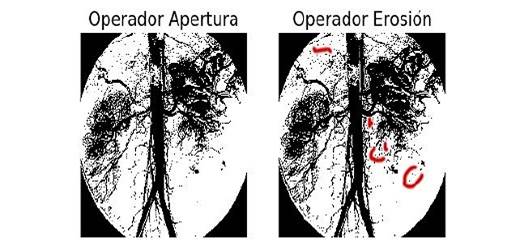 El rojo indica ruido no eliminado y no el da&ntilde;o original en el sistema circulatorio del paci&e.